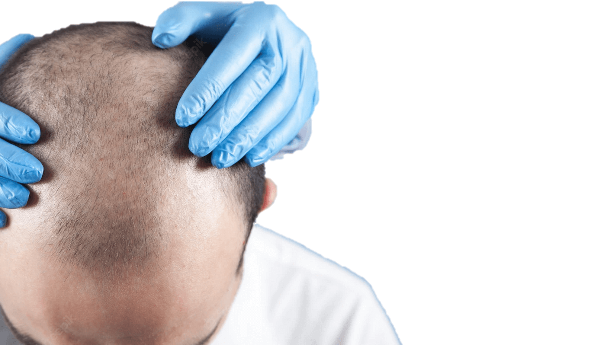 minoxidil 5 precio minoxidil 5 precio