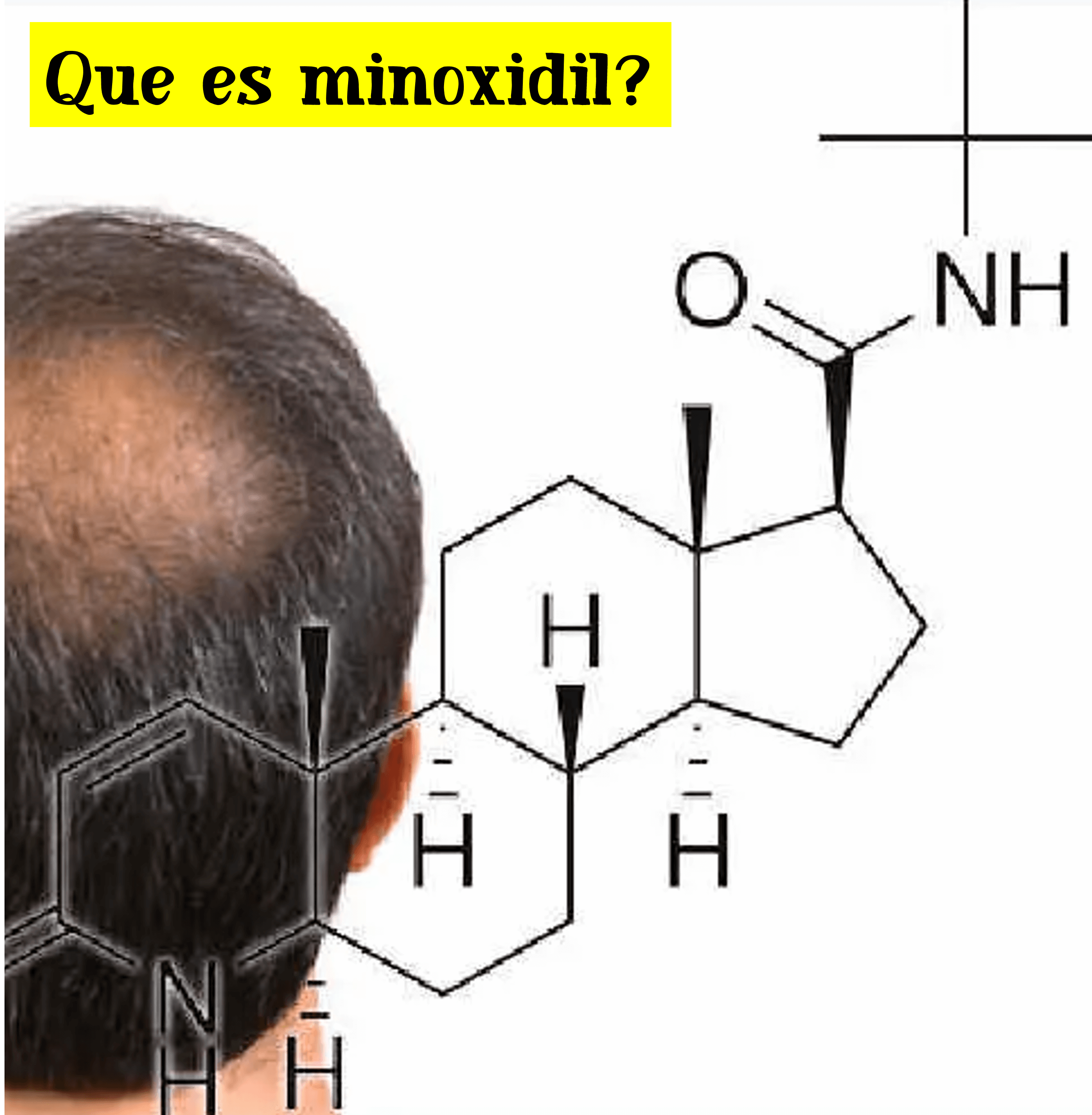 para que sirve el minoxidil para que sirve el minoxidil