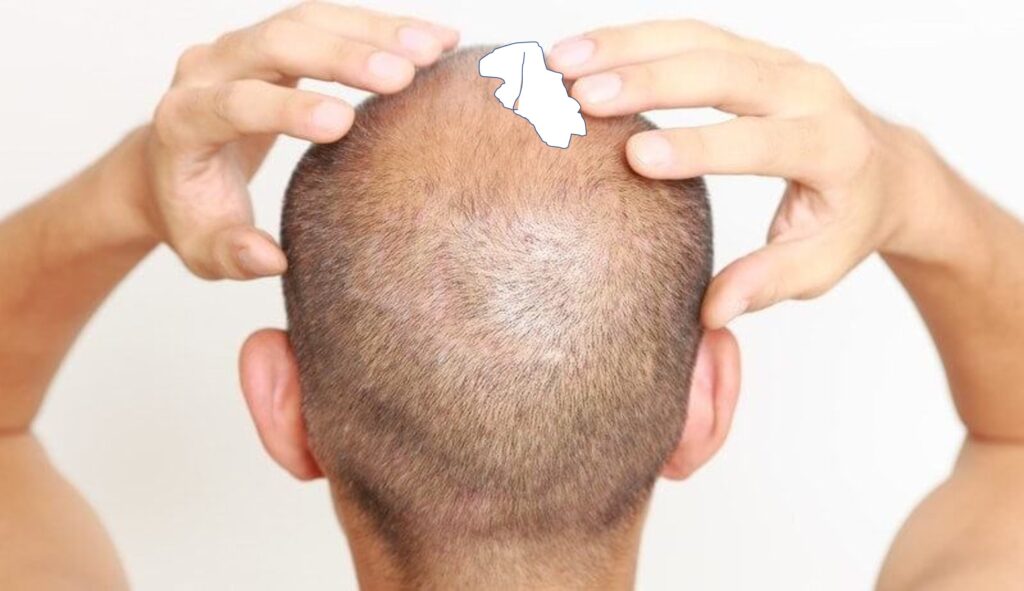 alopecia masculina espuma foam minoxidil kirkland espuma funciona