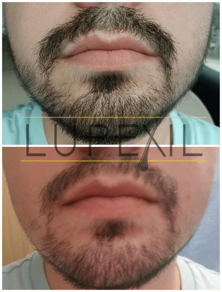 resultados con minoxidil 7 en la barba