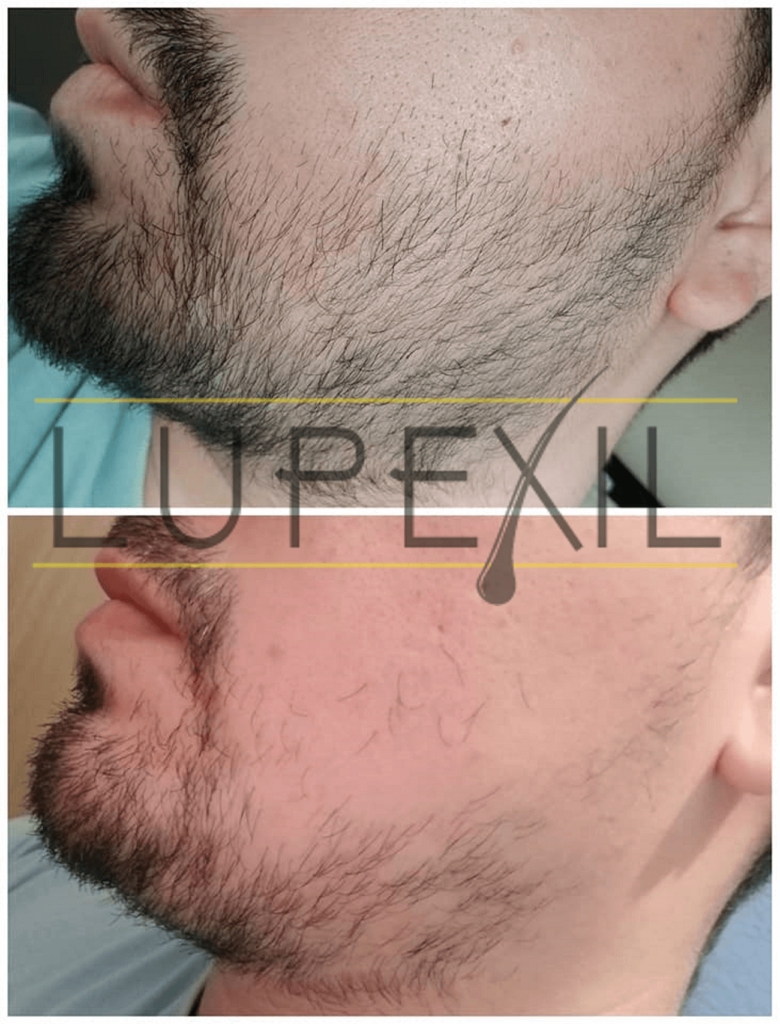 resultados con minoxidil 7 en la barba 4 meses