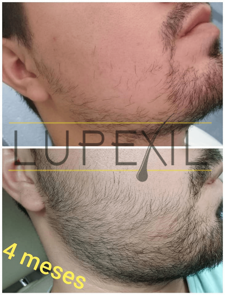 resultados con minoxidil 7 en la barba