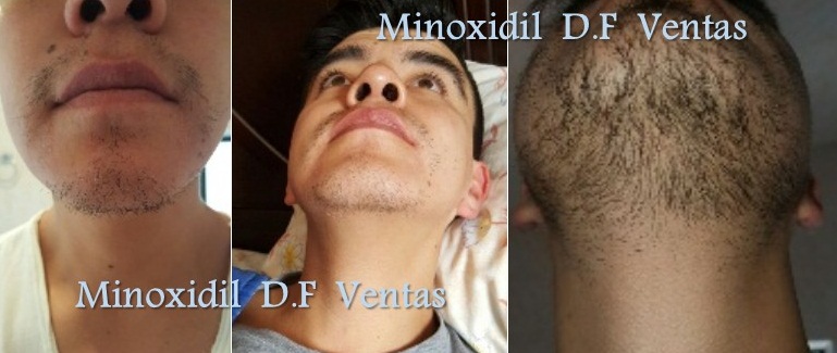 minoxidil barba resultados 1 mes