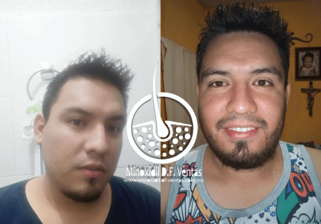 minoxidil barba resultados 1 mes