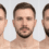 Resultados de minoxidil en barba antes y después
