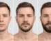 Resultados de minoxidil en barba antes y después